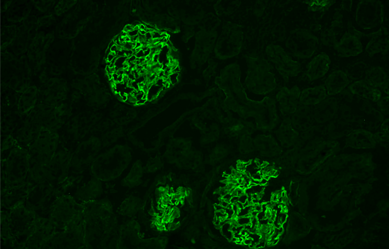 Eine fluoreszenzmikroskopische Aufnahme von Nierengewebe. Drei Glomeruli sind als leuchtend neongrüne Strukturen vor einem schwarzen Hintergrund sichtbar, was auf eine positive Immunfluoreszenzfärbung innerhalb dieser Bereiche hinweist.