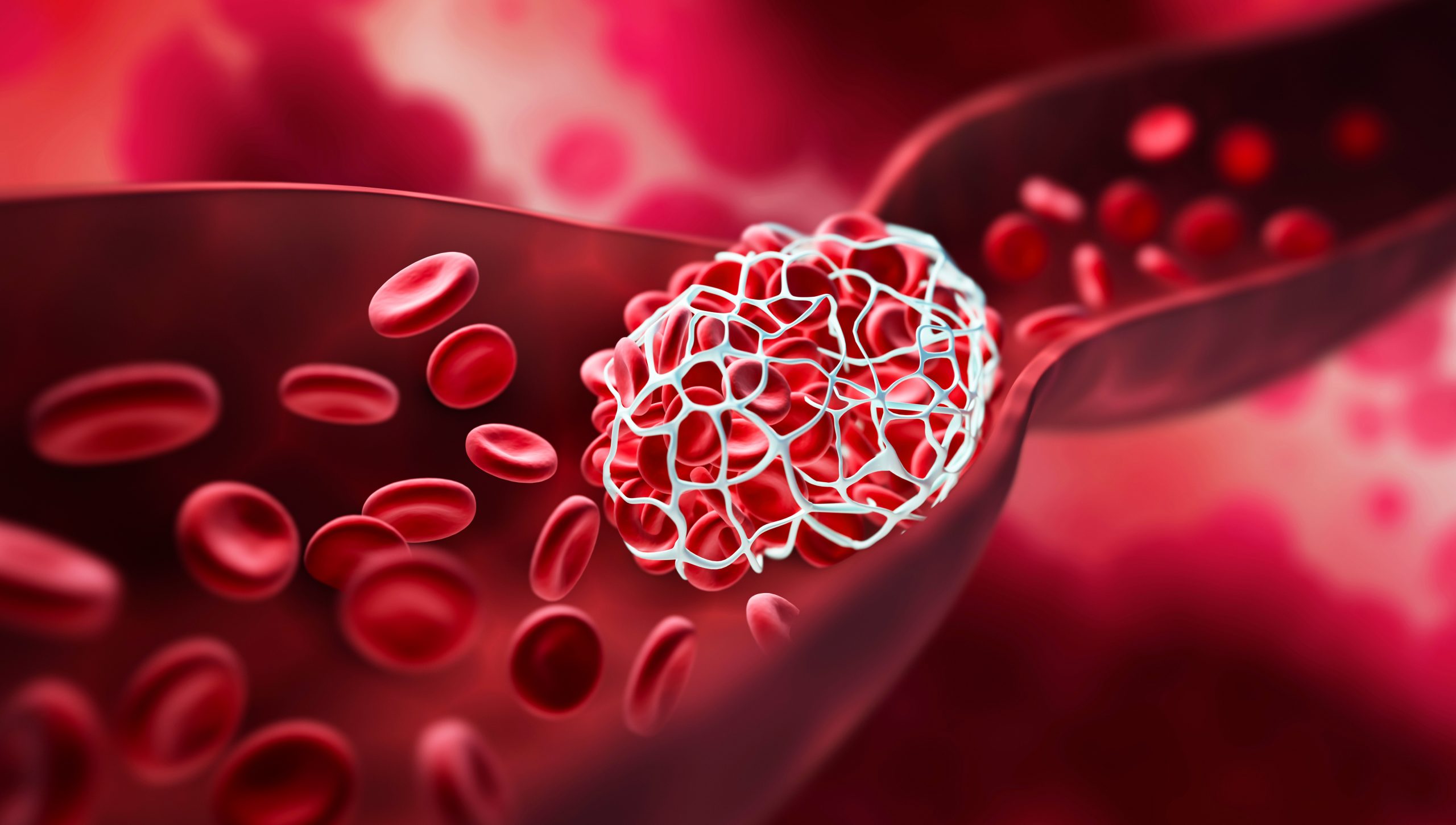 The image is a medical illustration of a blood clot forming inside a blood vessel. It shows red blood cells flowing around a large, white, mesh-like structure.