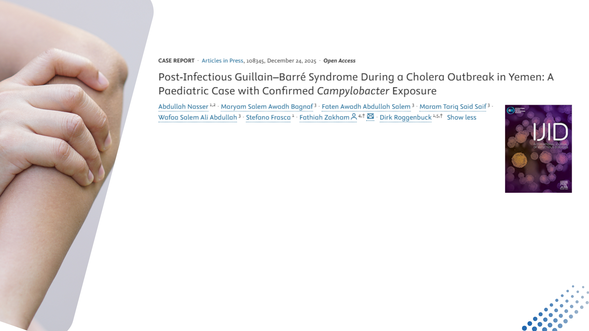 A medical case report header from the International Journal of Infectious Diseases (IJID). On the left, a hand is shown grasping an arm. The text to the right features the title: "Post-Infectious Guillain–Barré Syndrome During a Cholera Outbreak in Yemen: A Paediatric Case with Confirmed Campylobacter Exposure". Below the title, the authors' names and the IJID journal cover logo are visible.